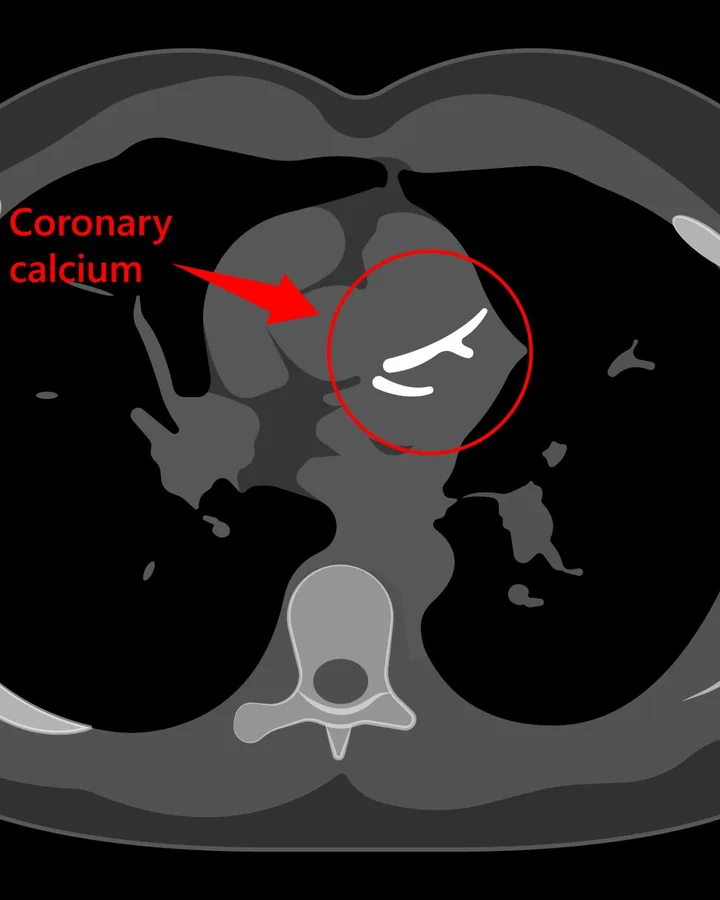A physician reviewing a coronary calcium score
