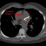 A concierge physician reviewing a coronary calcium score CT result with a member at Naples Concierge Health.