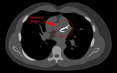 Should I get Coronary Calcium Scoring? A Naples Concierge Physician Explains