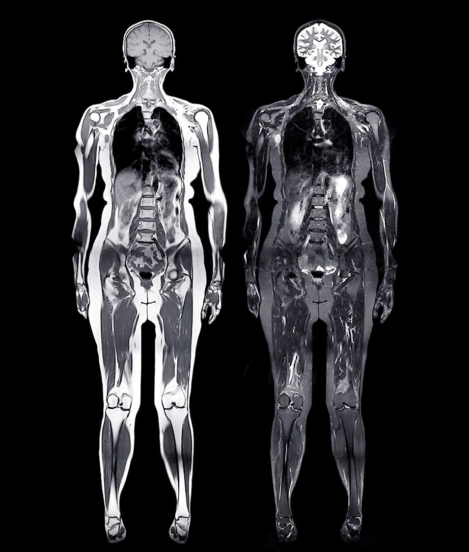 Mri,Whole,Body,Scans,Are,Beneficial,For,Early,Cancer,Detection, Beautiful old lady is doing exercise with dumbbell with the help of physiotherapist